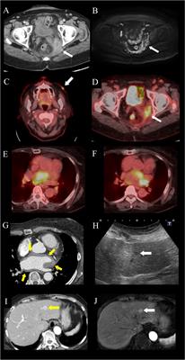 Case report: Rosai-Dorfman disease with rare extranodal lesions in the pelvis, heart, liver and skin